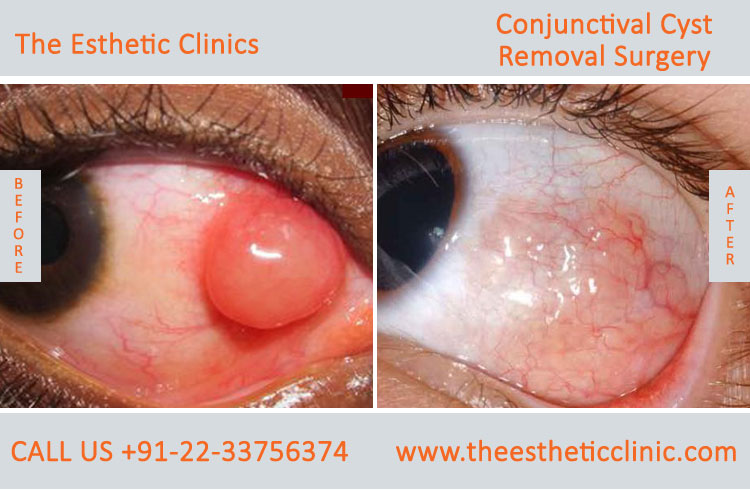 Conjuctival Cyst Removal Surgery, Eye Tumor Treatment before after photos in mumbai india